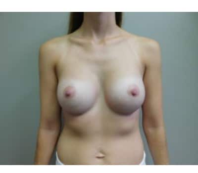 After Image: Breast Augmentation - front