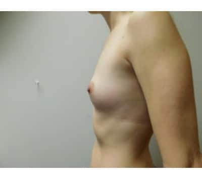 Before Image: Breast Augmentation - front