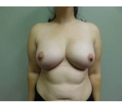 After Image: Breast Augmentation - front