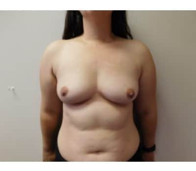 Before Image: Breast Augmentation - front