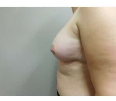 After Image: Breast Augmentation - front