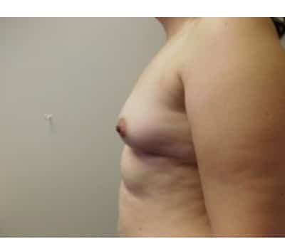 Before Image: Breast Augmentation - front