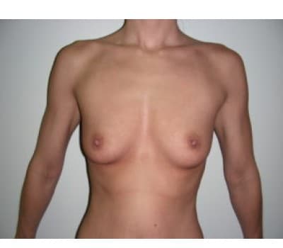 Before Image: Breast Augmentation - front
