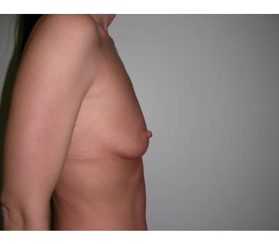 Before Image: Breast Augmentation - front