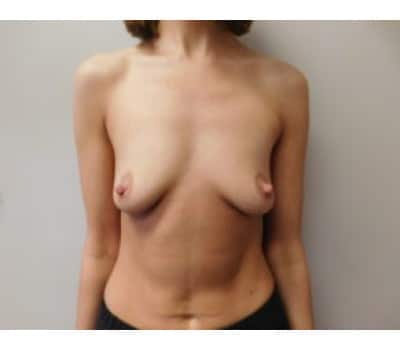 Before Image: Breast Augmentation - front