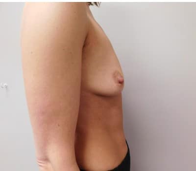 Before Image: Breast Augmentation - front