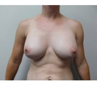 After Image: Breast Augmentation - front