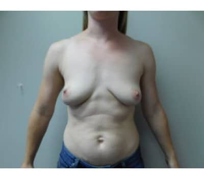Before Image: Breast Augmentation - front