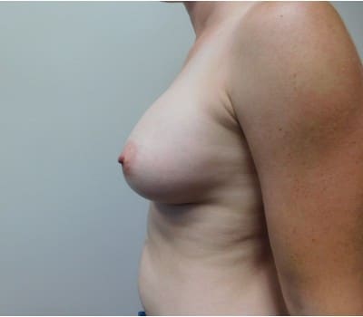 After Image: Breast Augmentation - front