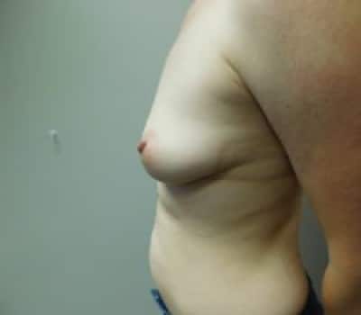 Before Image: Breast Augmentation - front
