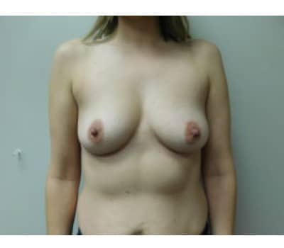 Before Image: Breast Augmentation - front