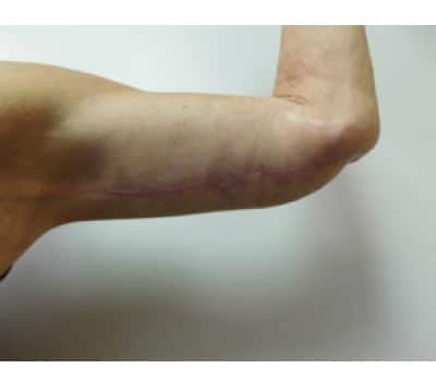 After Image: Brachioplasty - left-side