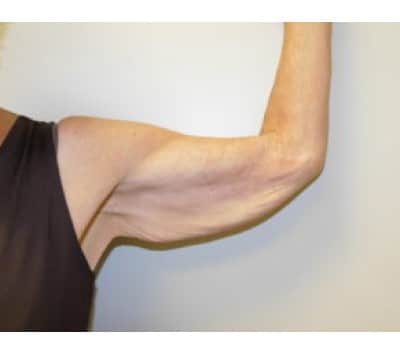 Before Image: Brachioplasty - left-side