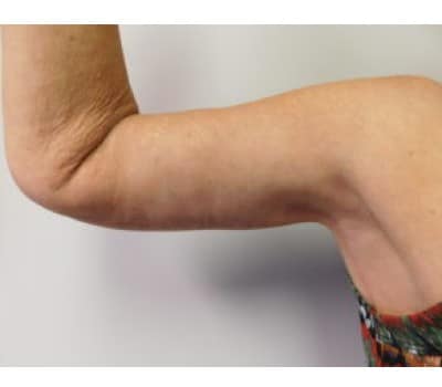 After Image: Brachioplasty - right-side