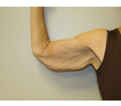 Before Image: Brachioplasty - right-side