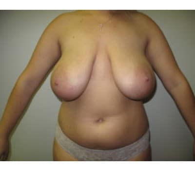 Before Image: Gynecomastia - front