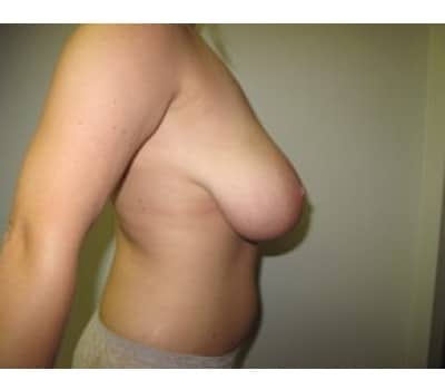 Before Image: Gynecomastia - other