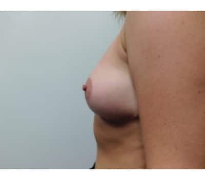 After Image: Breast Reduction - other