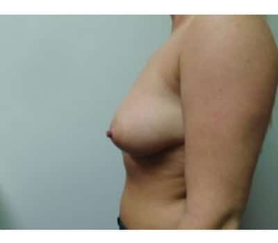 Before Image: Breast Reduction - other