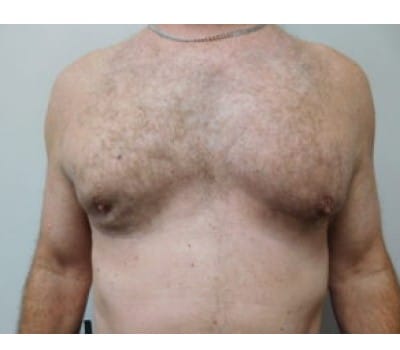 After Image: Complex Breast Issues - front
