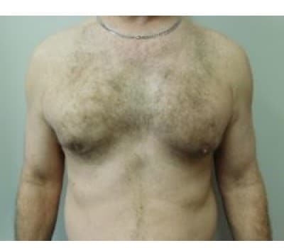 Before Image: Complex Breast Issues - front
