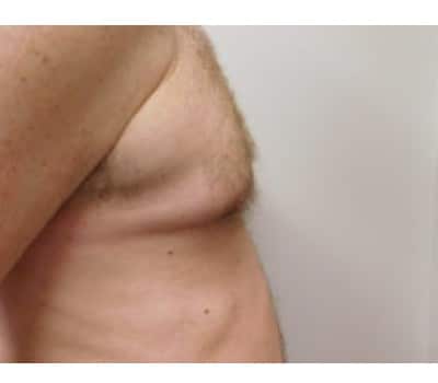 Before Image: Complex Breast Issues - other
