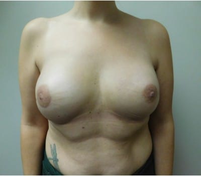 After Image: Complex Breast Issues - front