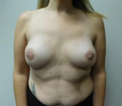 Before Image: Complex Breast Issues - front
