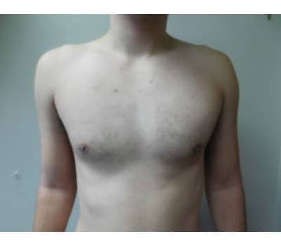 After Image: Gynecomastia - front