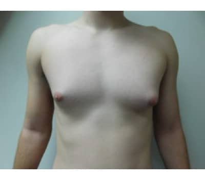 Before Image: Gynecomastia - front