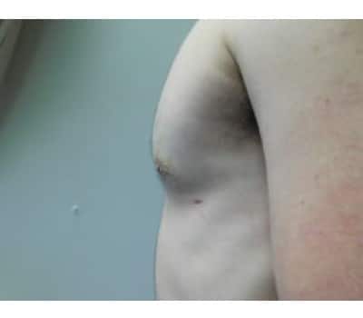 After Image: Gynecomastia - other