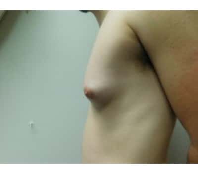 Before Image: Gynecomastia - other