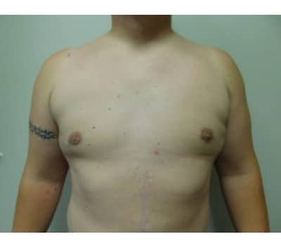 After Image: Gynecomastia - front