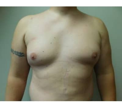 Before Image: Gynecomastia - front