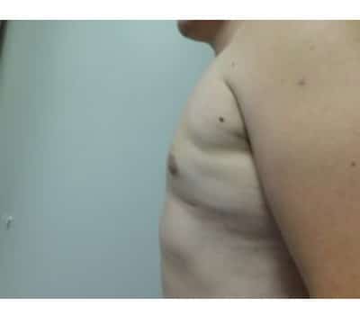 After Image: Gynecomastia - other