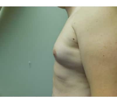 Before Image: Gynecomastia - other
