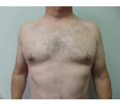 After Image: Gynecomastia - front