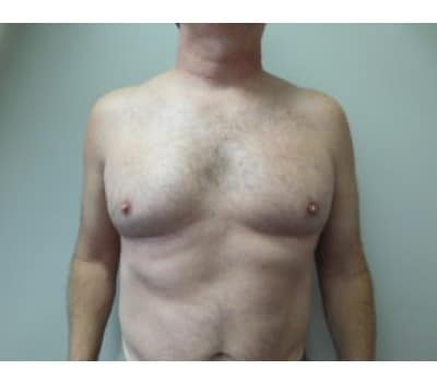 Before Image: Gynecomastia - front