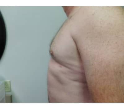After Image: Gynecomastia - other