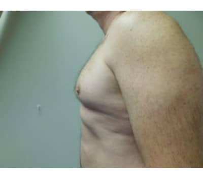 Before Image: Gynecomastia - other