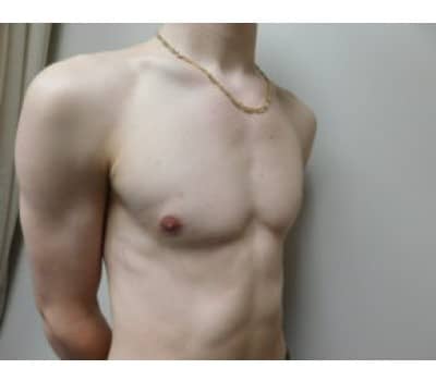 After Image: Gynecomastia - front