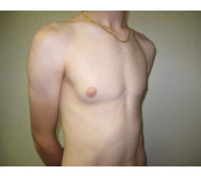 Before Image: Gynecomastia - front