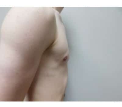 After Image: Gynecomastia - other