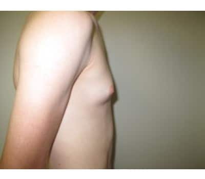 Before Image: Gynecomastia - other