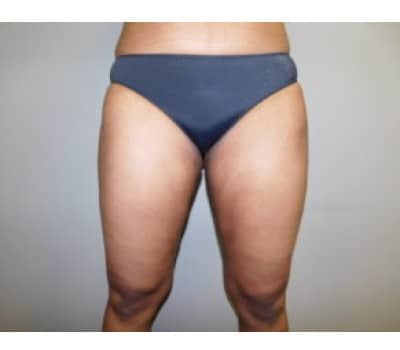 After Image: Liposuction - front