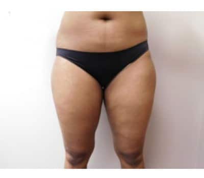 Before Image: Liposuction - front