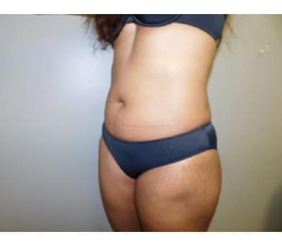 After Image: Liposuction - left-side