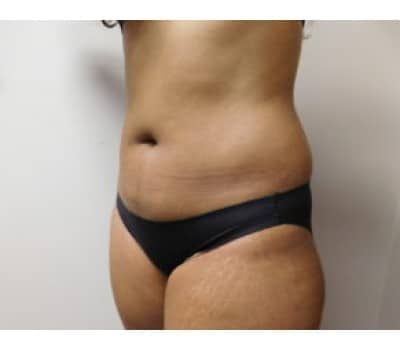 Before Image: Liposuction - left-side