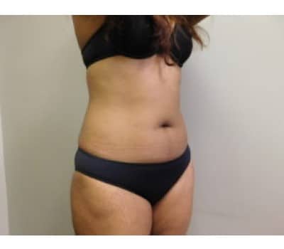 After Image: Liposuction - right-side