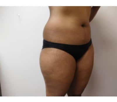 Before Image: Liposuction - right-side